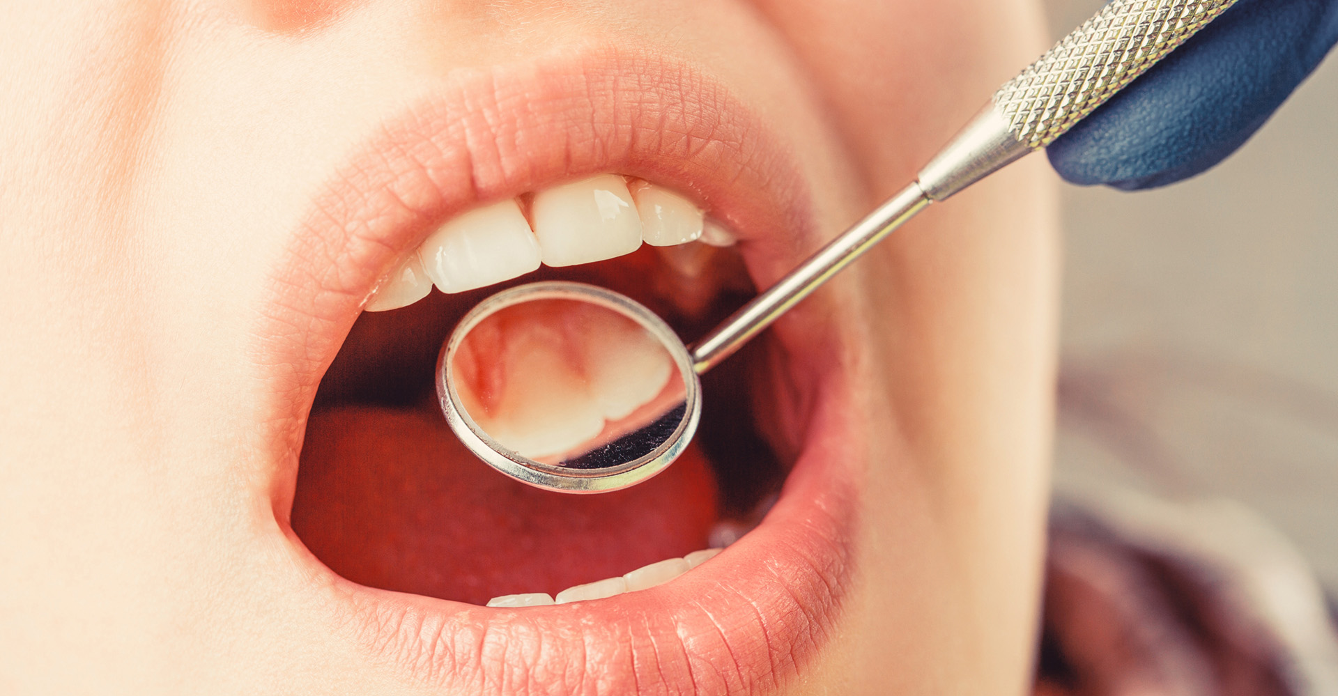 Zbliżenie na badanie dziąseł lusterkiem i zgłębnikiem stomatologicznym podczas leczenia chorób przyzębia w gabinecie periodontologii w Nowym Mieście nad Pilicą